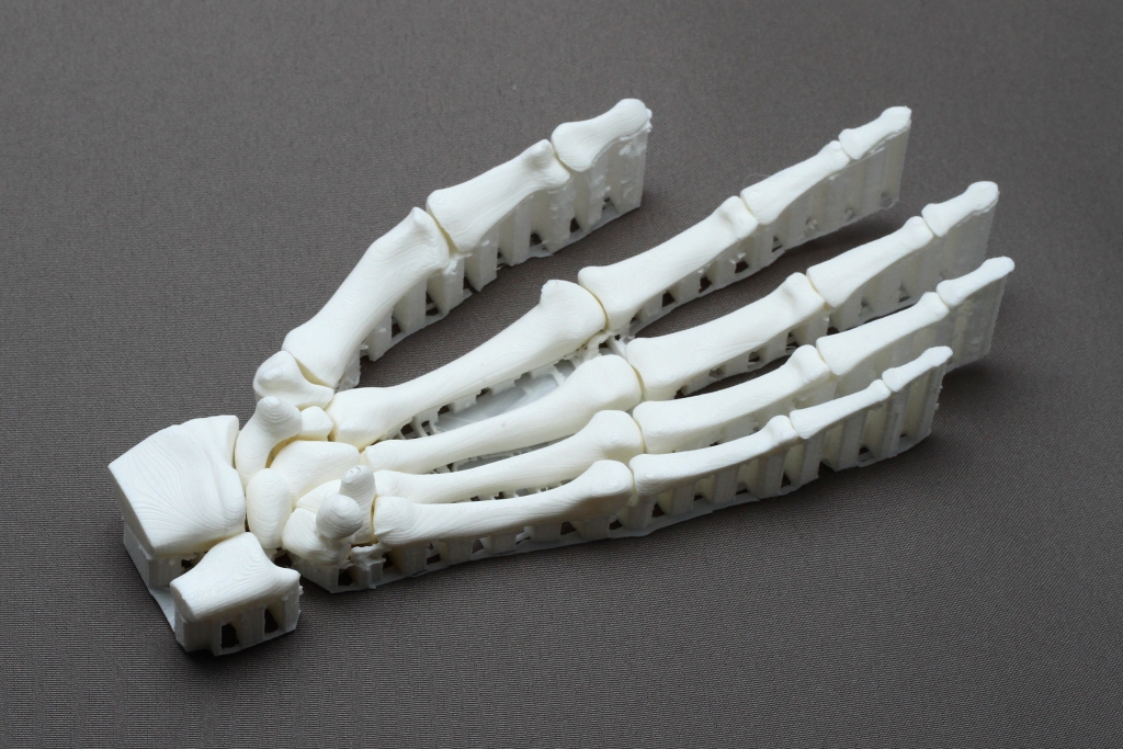 Anatomisches Handmodell im 3D-Druck zur Ableitung für die Gestaltung einer individuellen Endoprothese.