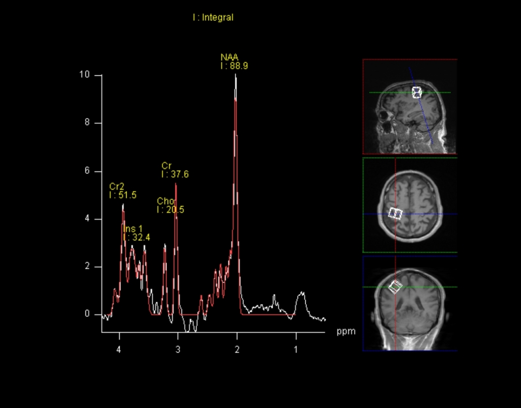 Magnetresonanz-Spektroskopie der Hirnregion zuständig für aktive Bewegung 