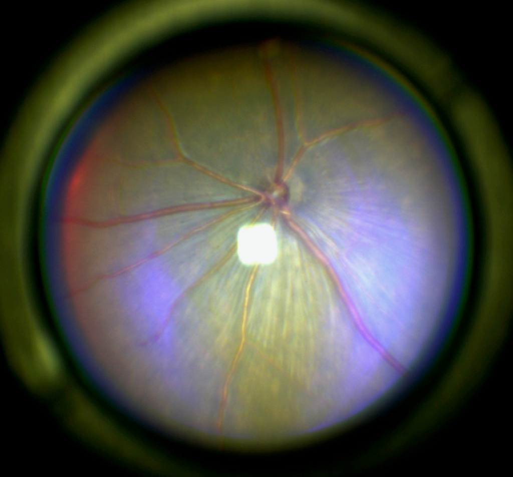 Blick auf den Augenhintergrund mit Darstellung der Blutgefäße