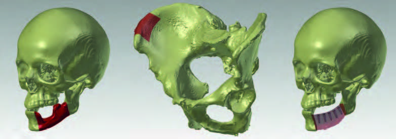 Virtuelles 3D-Modell eines Schädels mit Markierung des zu entfernenden Teils des Unterkiefers; b: Teilstück des Beckenkammes als Transplantat markiert; c: virtuell eingepasstes Transplantat am Kiefer mit der Planung von Implantaten für späteren Zahnersatz.