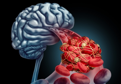 Blutgerinnsel im Gehirn