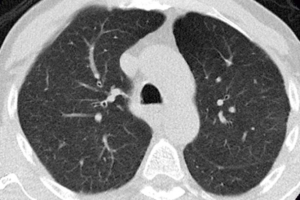 CT-Aufnahme einer gesunden Lungen (© Charité | Mirja Mittermaier) 