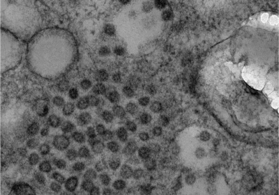 SARS-CoV-2 Partikel in einer Zelle eines Nierenorganoids_© Uniklinik RWTH Aachen
