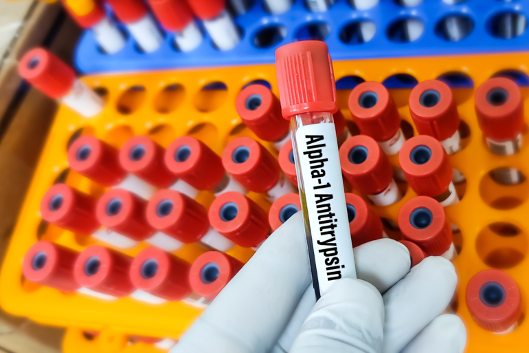 Scientist holds a blood sample tube for Alpha 1 antitrypsin(A1AT