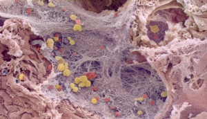Covid 19 Lung
