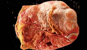 Computer-generierte Darstellung einer humanen Plazenta, gemessen mit der Methode der virtuellen 3D Histologie. Virtuell lassen sich beliebige Schnittbilder mit hoher Auflösung durch das Organ legen.Damit können die Längenskalen der Anatomie und Histologie verbunden und das ganz Organ z.B. auf Auffälligkeiten der Gewebearchitektur untersucht werden. Aus: J. Reichmann et al., PNAS Nexus 2025